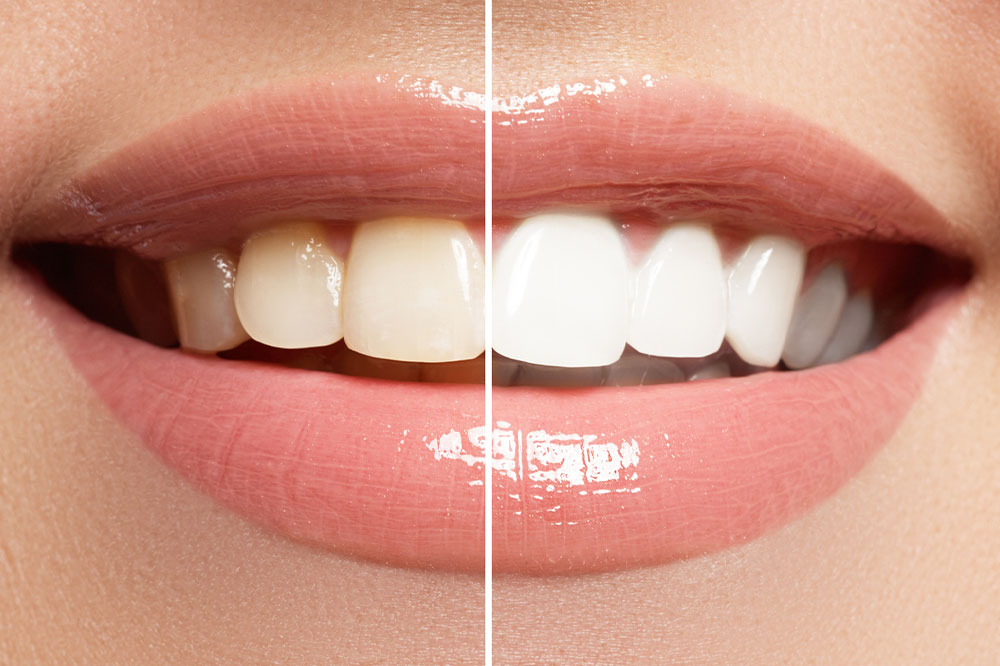 5 reasons at-home teeth whitening isn’t ideal always